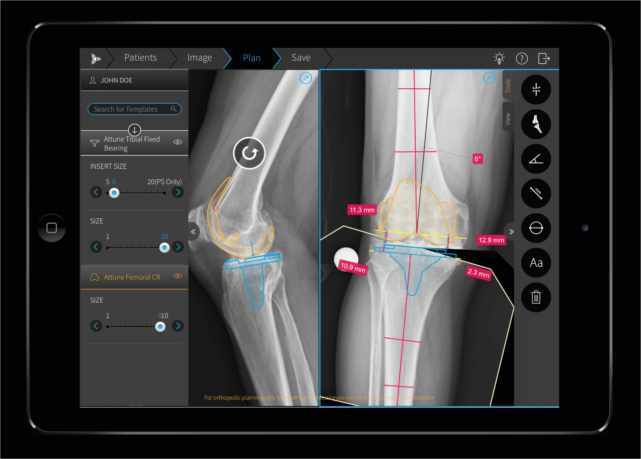 brainlab increases automation orthopedic digital templating