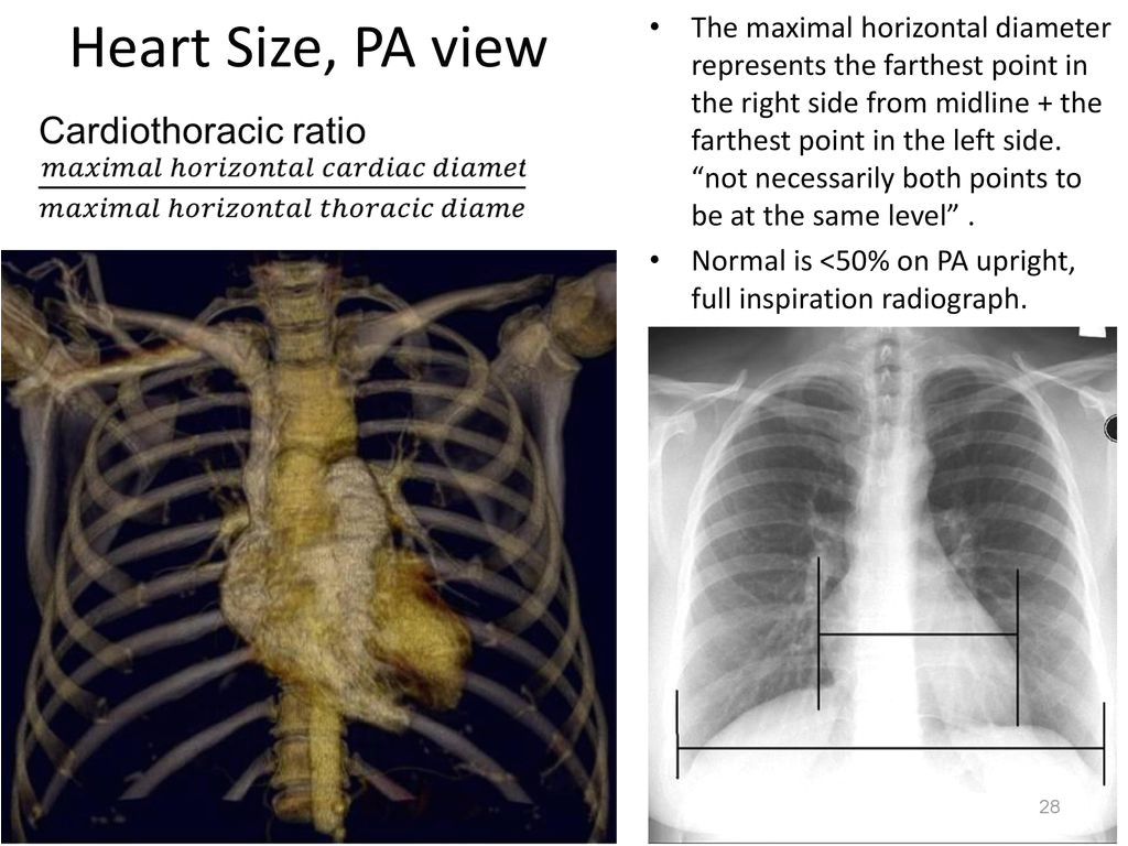 heart size 2c pa view jpg