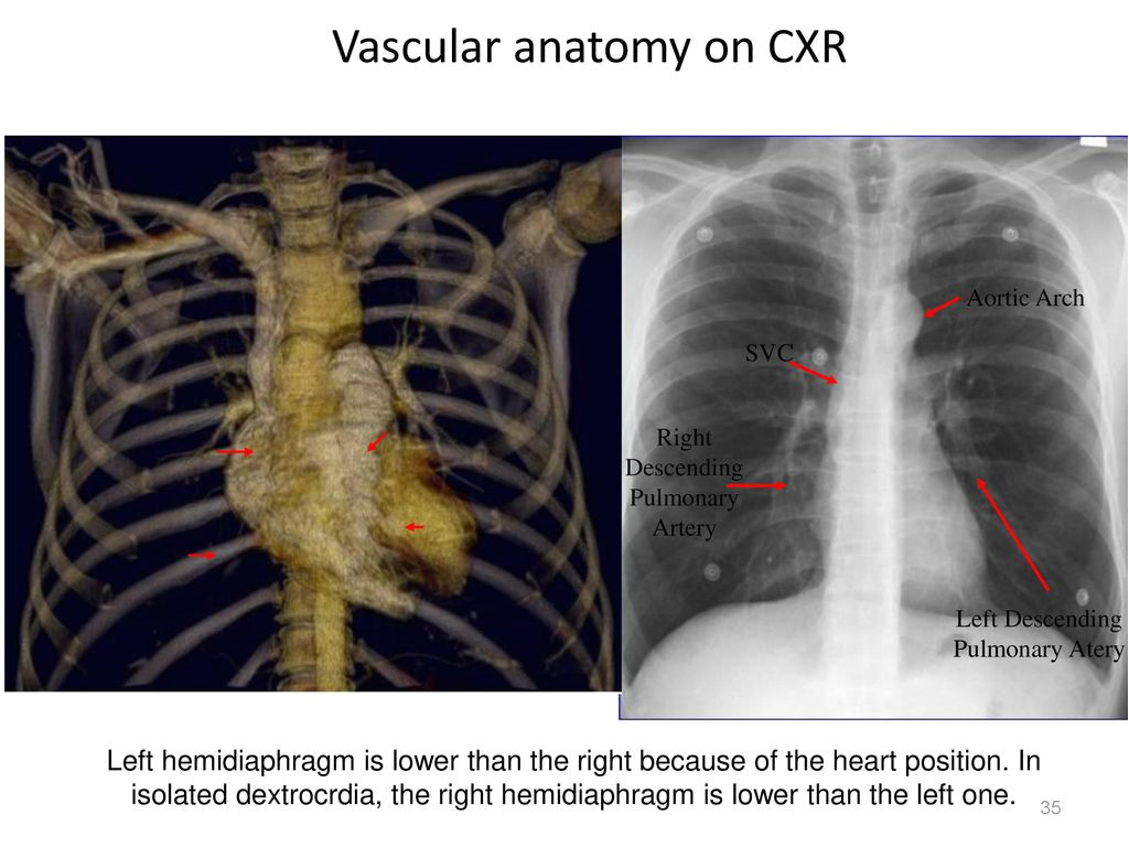 isnpexp vascular anatomy on cxr jpg