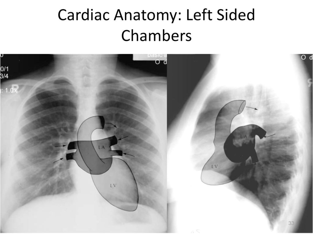 cardiac anatomy 3a left sided chambers jpg