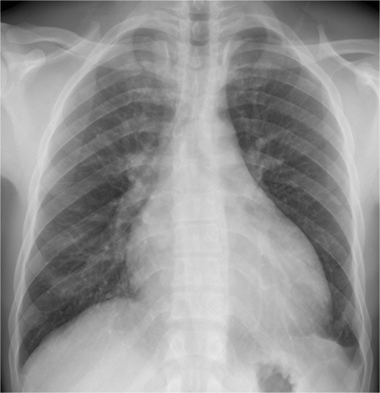 Right Cardiac Border X Ray Caceres Corner Case 198 solved European Diploma Of